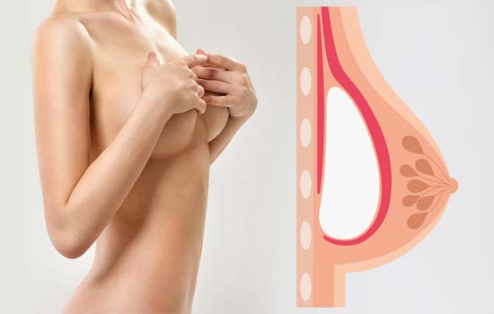 ניתוח הגדלת שדיים מתחת לשריר