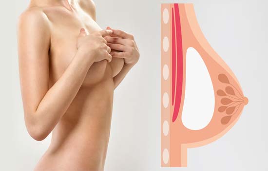 ניתוח הגדלת שדיים מעל לשריר