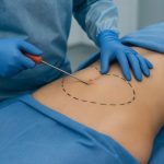 ניתוח שאיבת שומן ומתיחת בטן